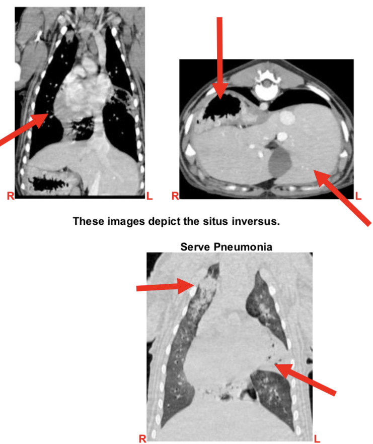 Situs Inversus