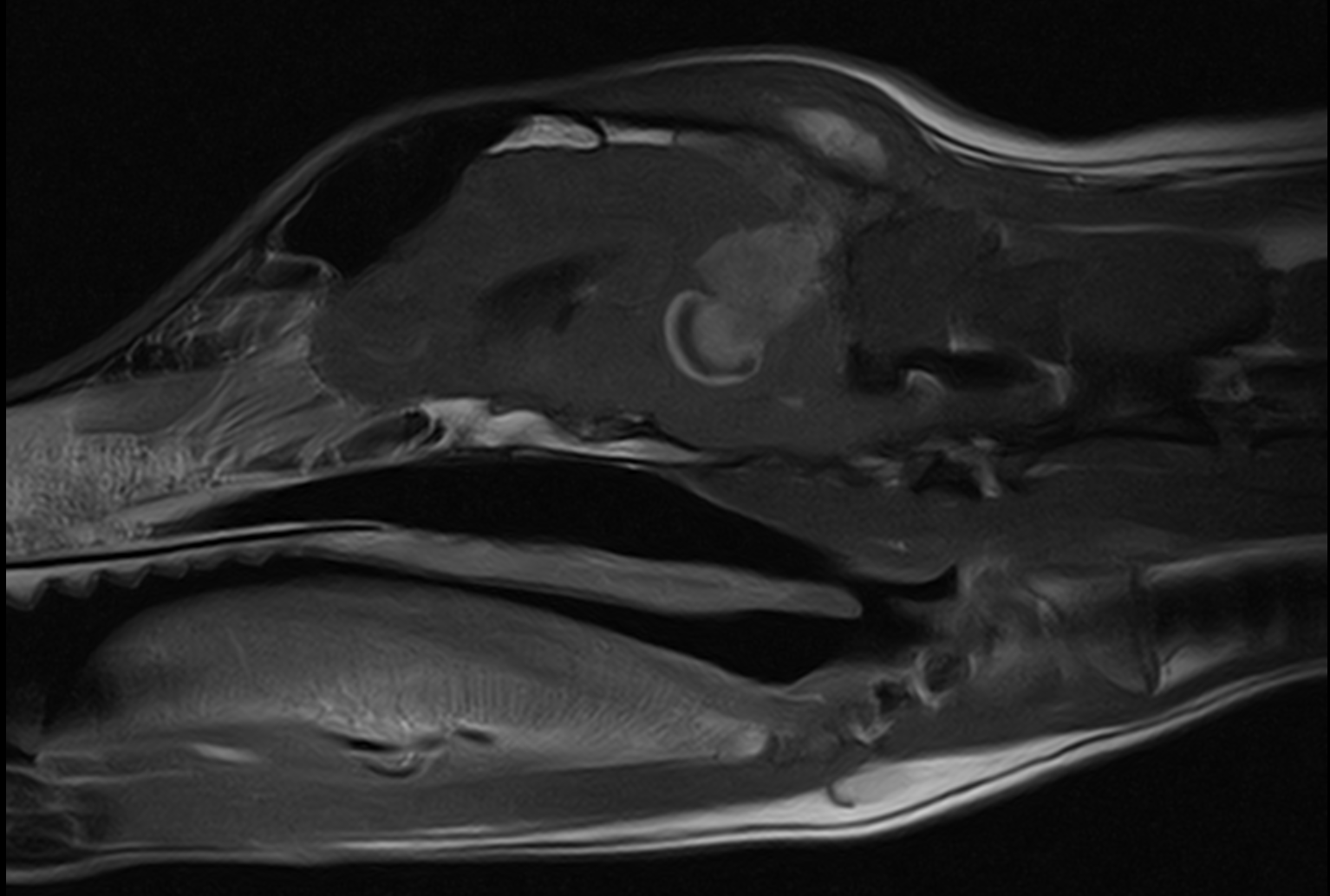 Brain Tumor MRI T1 Post Contrast Sagital