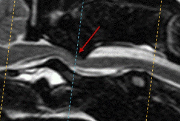 Specialist Reports Success With New Technique For Spinal Malformations 