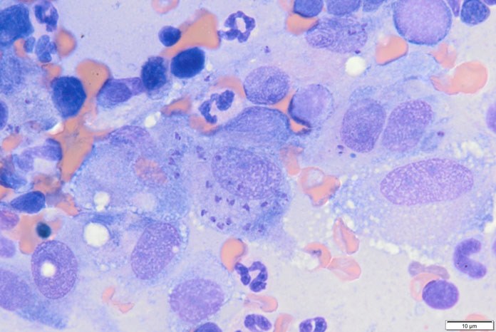 Photo: Bone marrow cytology showing macrophages with numerous intracellular organisms consistent with Leishmania species amastigotes. Credit Charalampos Attipa